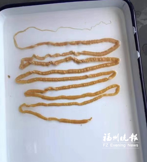 从阿强体内排出的牛带绦虫.医生供图